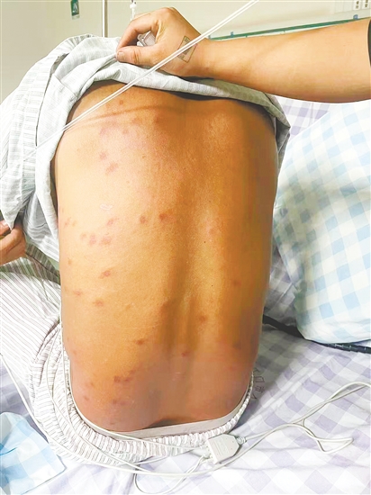 患者全身多處被馬蜂蜇傷。